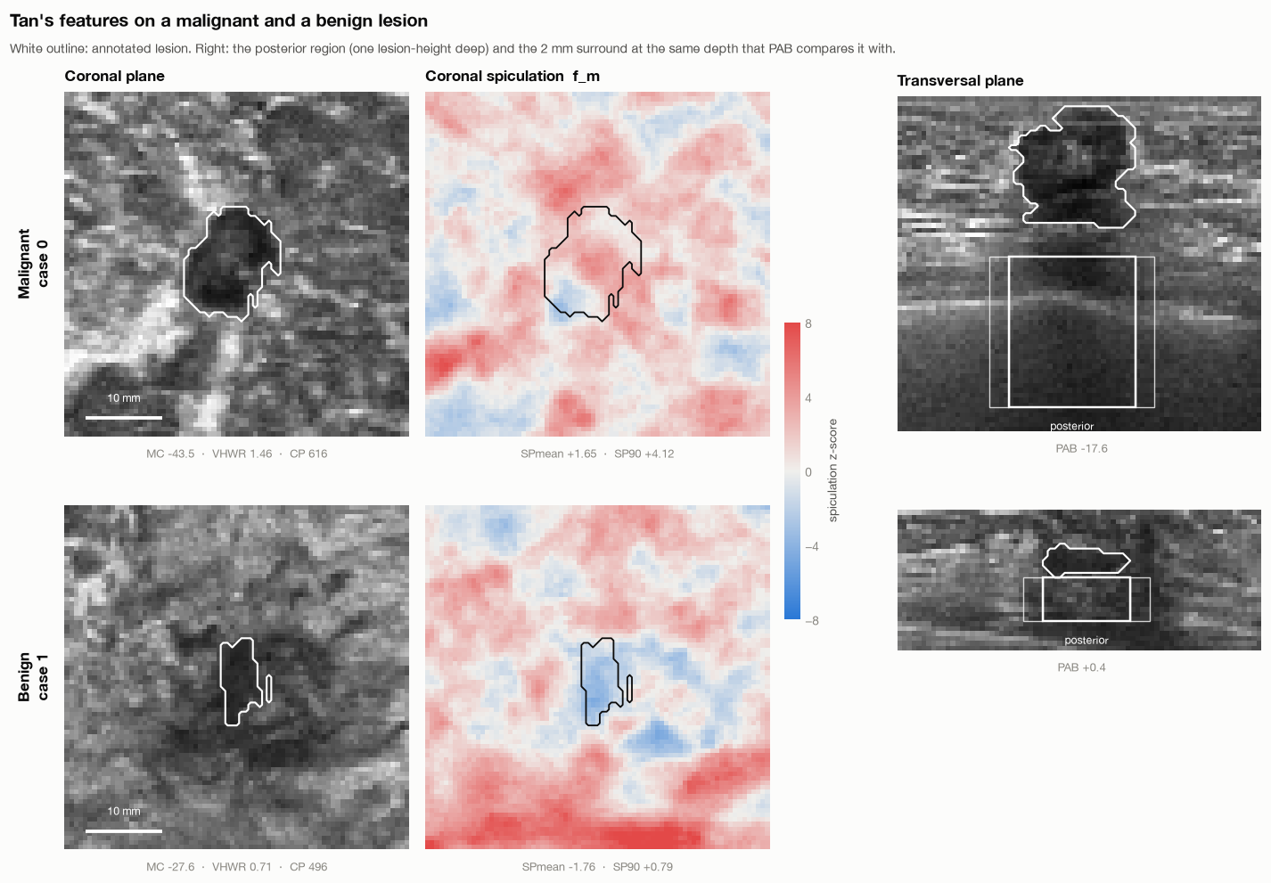 Coronal plane, coronal spiculation map and transversal plane with the posterior region for a malignant and a benign lesion