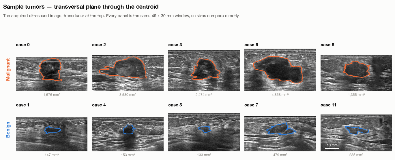 ABUS Classification, Part 1: Mammography, Ultrasound, and Why 3D